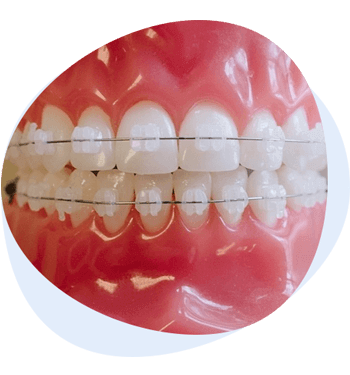 ceramic braces