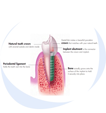 implants teeth