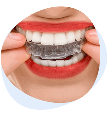 invisible aligners