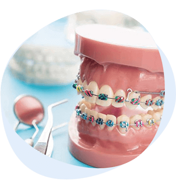 lingual braces